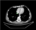 June 2024, tumor image